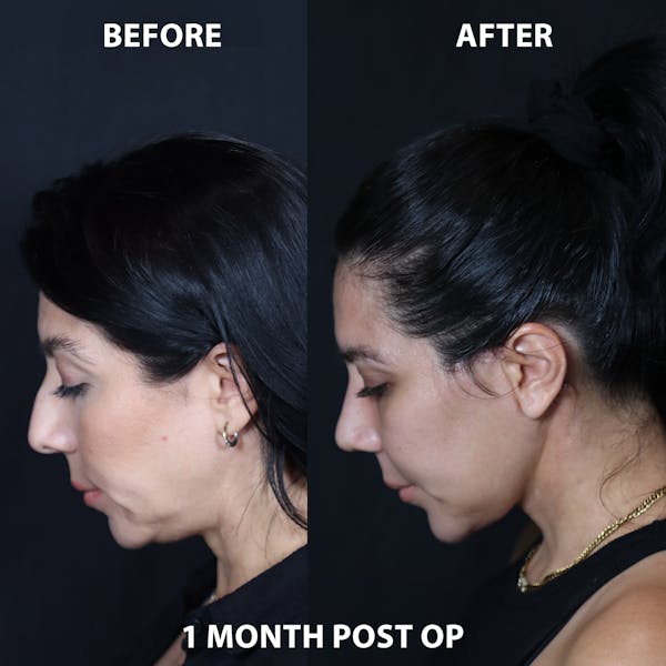 Full Face Rejuvenation Before & After Gallery - Patient 415369 - Image 1