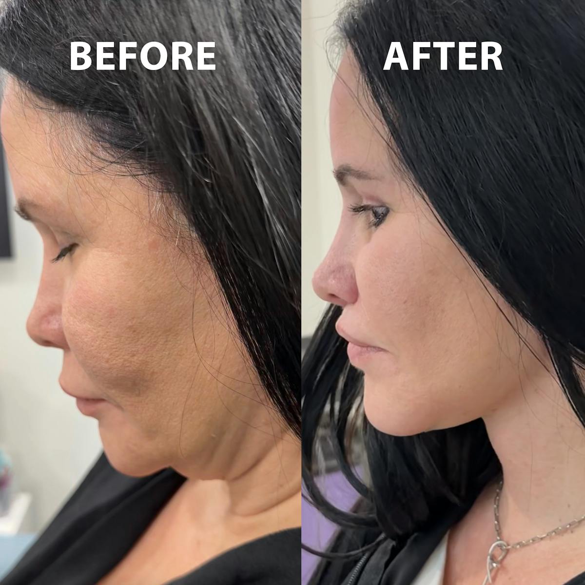 Full Face Rejuvenation Before & After Gallery - Patient 369861 - Image 2