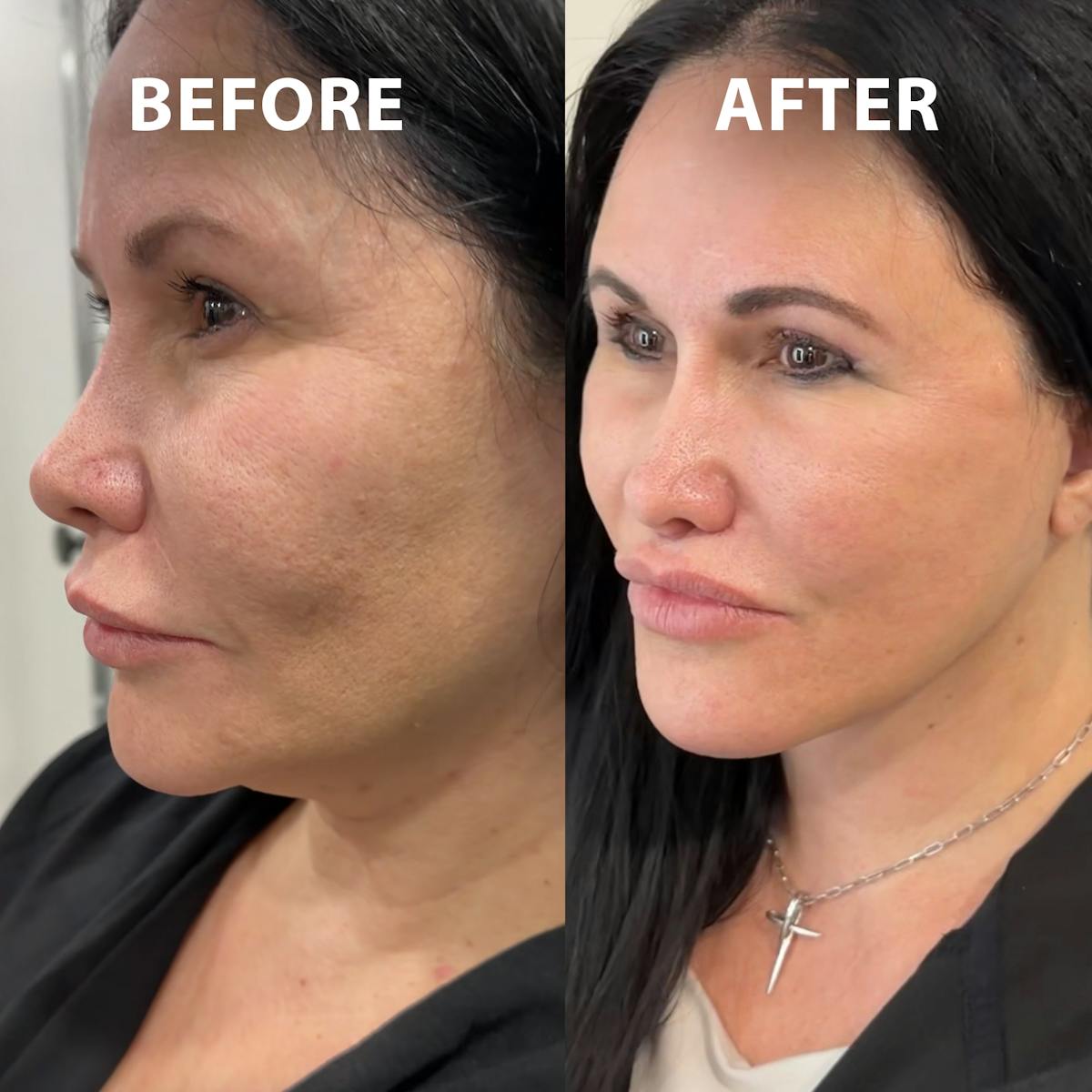 Full Face Rejuvenation Before & After Gallery - Patient 369861 - Image 1