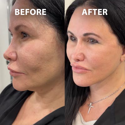 Full Face Rejuvenation Before & After Gallery - Patient 369861 - Image 1
