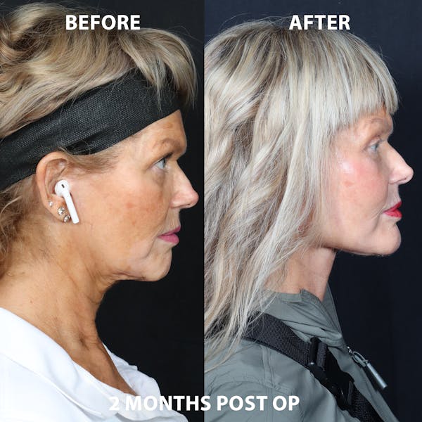 Full Face Rejuvenation Before & After Gallery - Patient 378517 - Image 1
