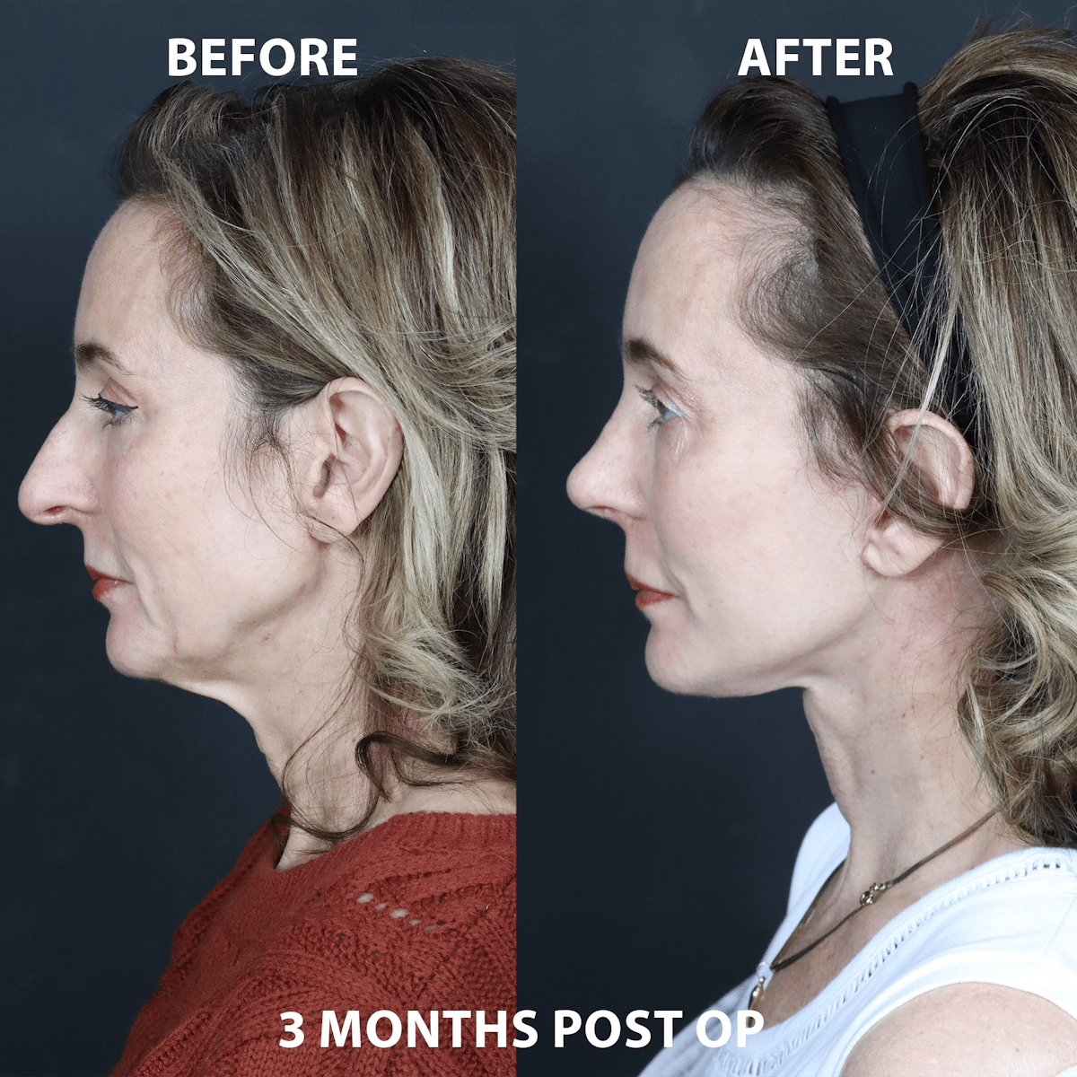 Full Face Rejuvenation Before & After Gallery - Patient 158974 - Image 1