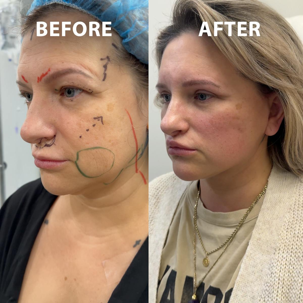 Full Face Rejuvenation Before & After Gallery - Patient 320571 - Image 1