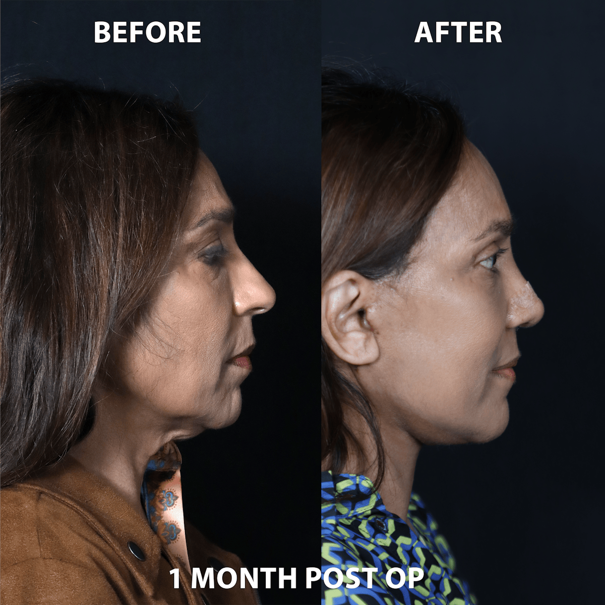Full Face Rejuvenation Before & After Gallery - Patient 363834 - Image 1