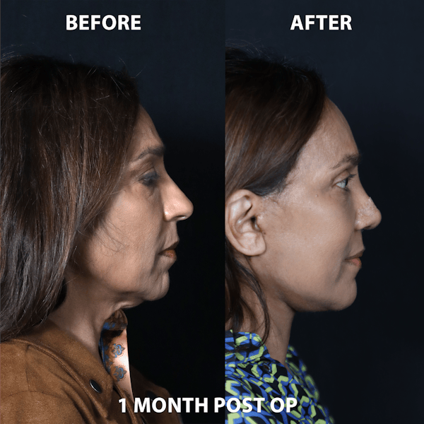 Full Face Rejuvenation Before & After Gallery - Patient 363834 - Image 1