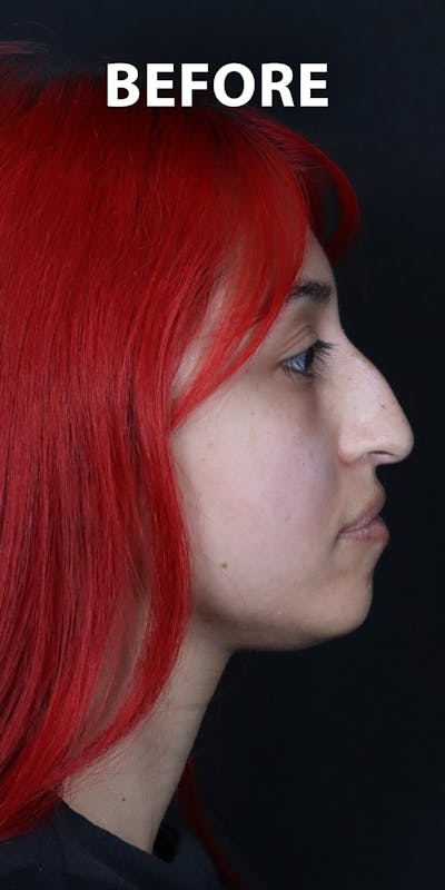 Before & Afters Before & After Gallery - Patient 417314 - Image 1