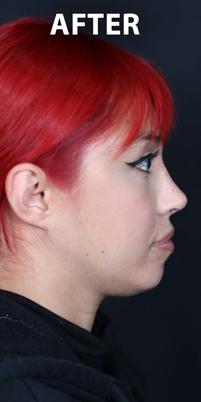 Before & Afters Before & After Gallery - Patient 417314 - Image 2