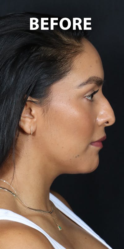 Before & Afters Before & After Gallery - Patient 278094 - Image 1