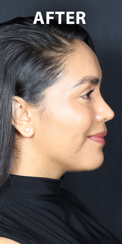 Before & Afters Before & After Gallery - Patient 278094 - Image 2