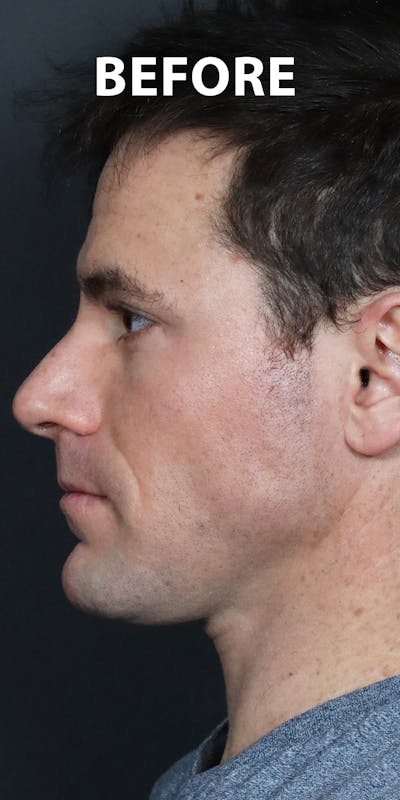 Before & Afters Before & After Gallery - Patient 528811 - Image 1