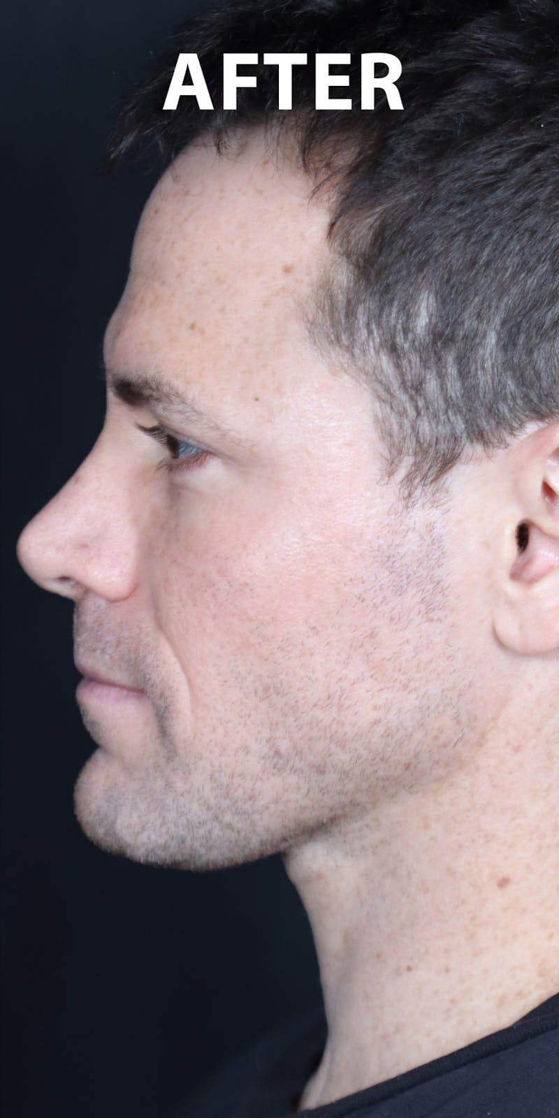 Before & Afters Before & After Gallery - Patient 528811 - Image 2