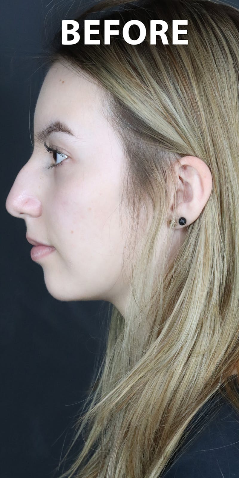 Before & Afters Before & After Gallery - Patient 299944 - Image 1