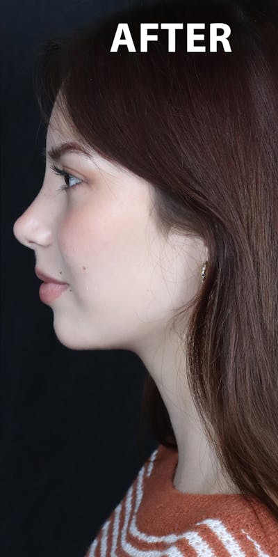 Before & Afters Before & After Gallery - Patient 299944 - Image 2