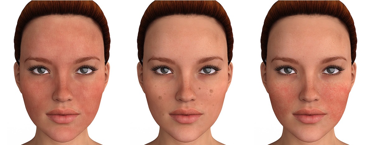 Illustration showing common IPL treatment concerns including redness, sun spots, hyperpigmentation, and uneven skin tone on the face