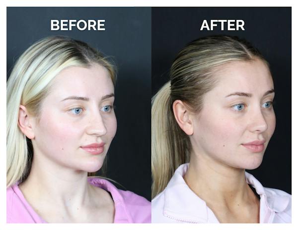 Revision Rhinoplasty Before & After Gallery - Patient 287533 - Image 1