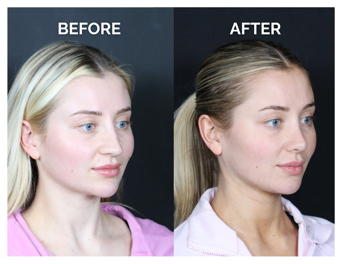 Revision Rhinoplasty Before & After Gallery - Patient 287533 - Image 2