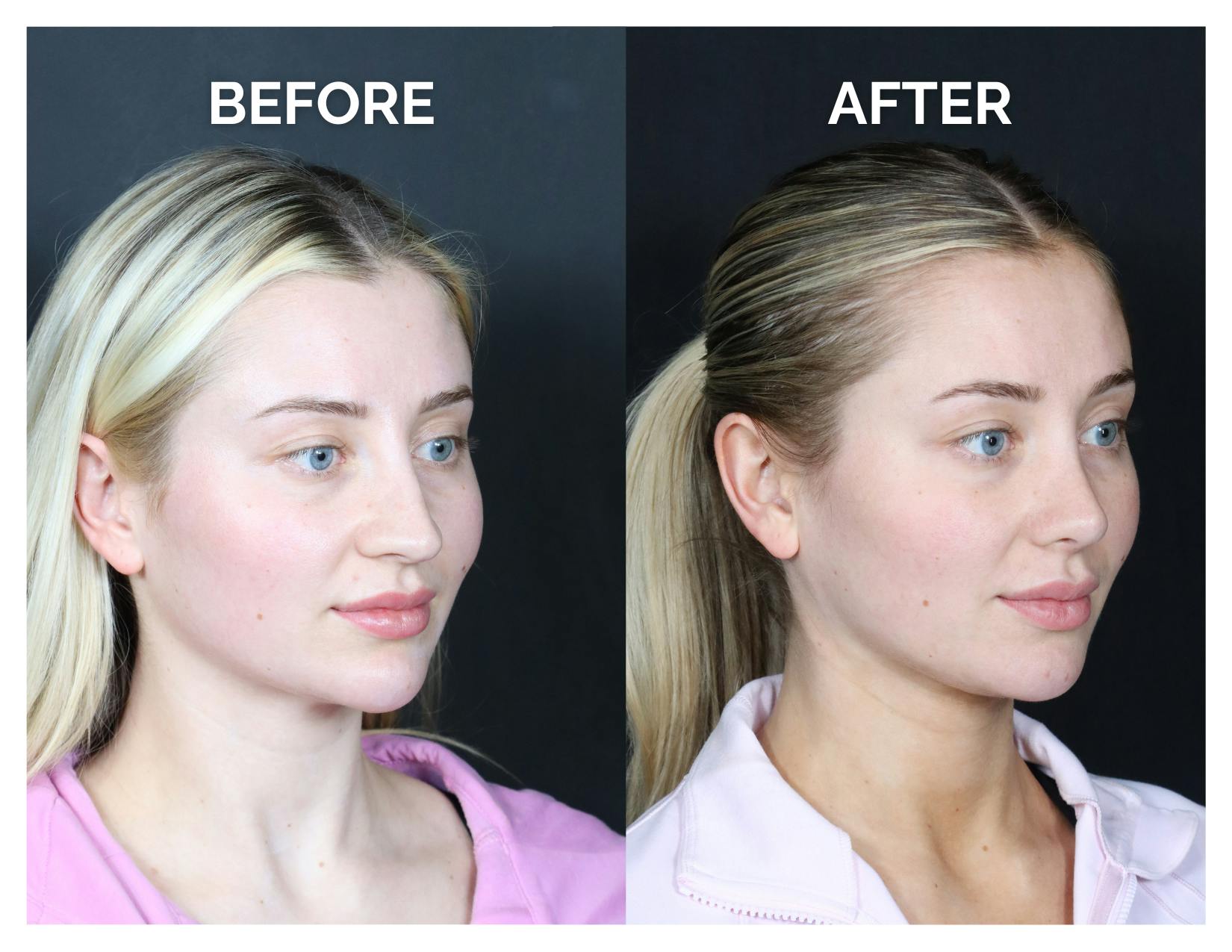Revision Rhinoplasty Before & After Gallery - Patient 287533 - Image 2