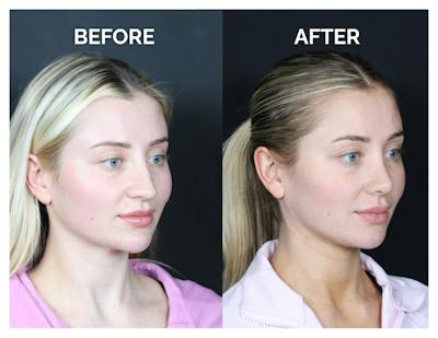 Revision Rhinoplasty Before & After Gallery - Patient 287533 - Image 1
