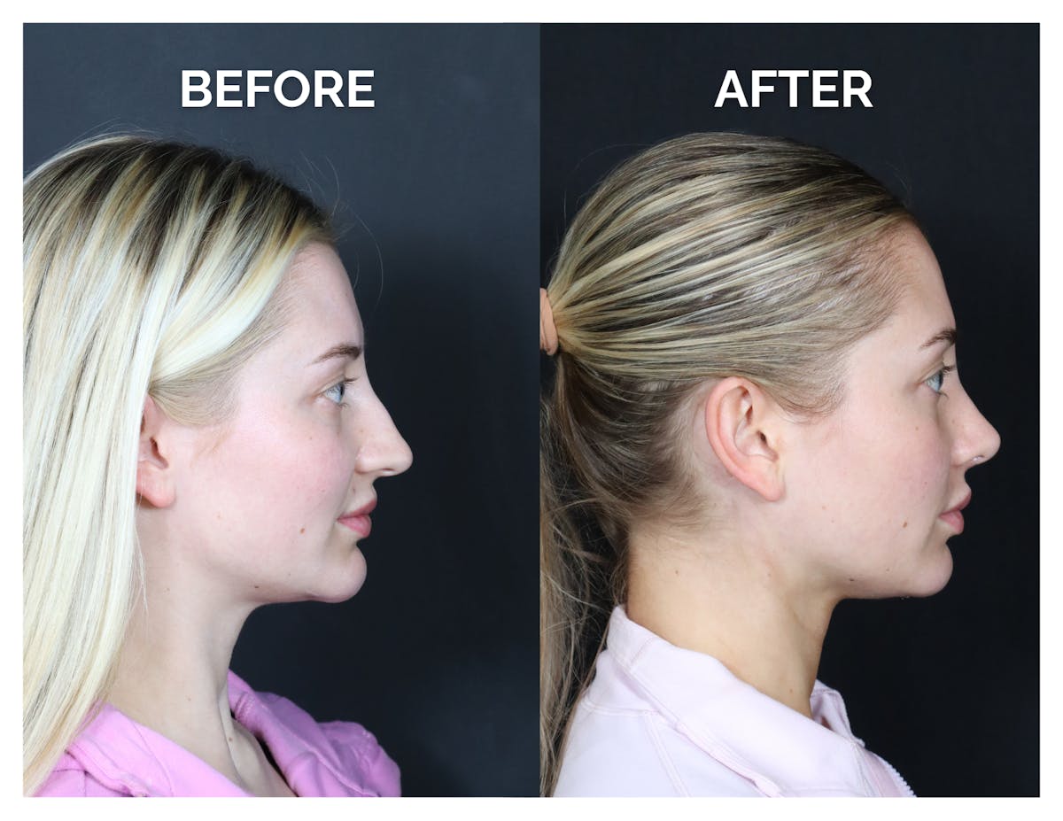 Revision Rhinoplasty Before & After Gallery - Patient 287533 - Image 3