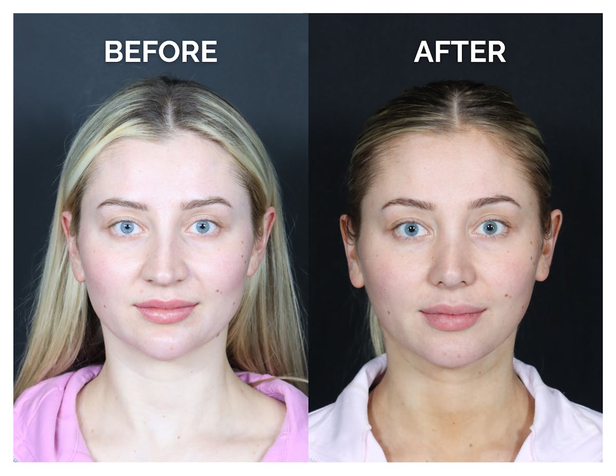 Revision Rhinoplasty Before & After Gallery - Patient 287533 - Image 1