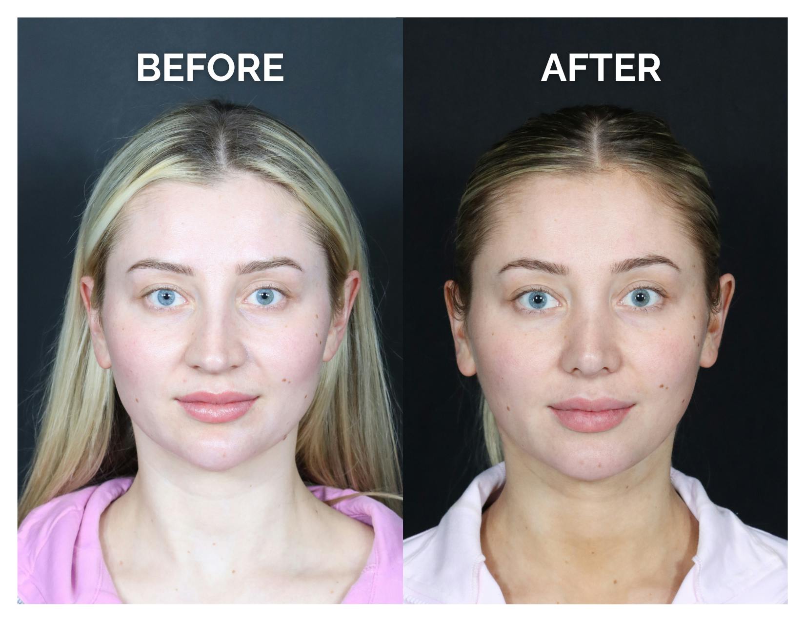 Revision Rhinoplasty Before & After Gallery - Patient 287533 - Image 1