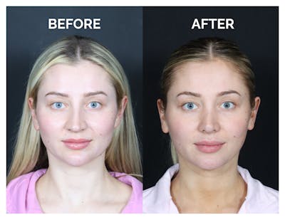 Revision Rhinoplasty Before & After Gallery - Patient 287533 - Image 1