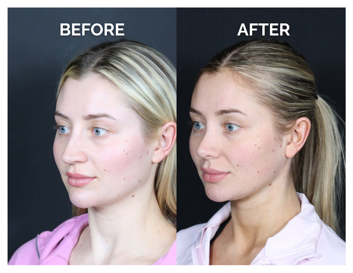 Revision Rhinoplasty Before & After Gallery - Patient 287533 - Image 4