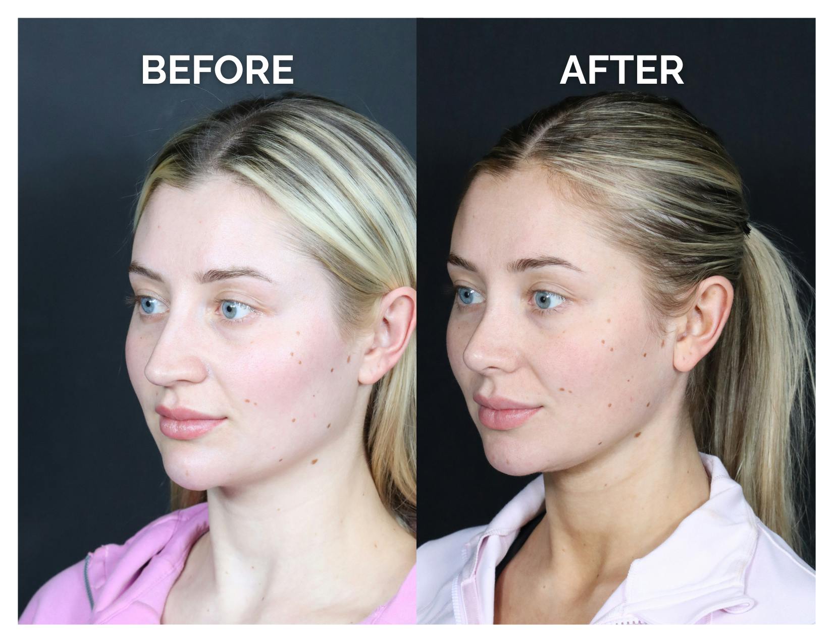Revision Rhinoplasty Before & After Gallery - Patient 287533 - Image 4