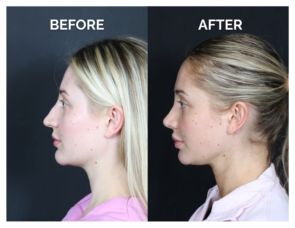 Revision Rhinoplasty Before & After Gallery - Patient 287533 - Image 5