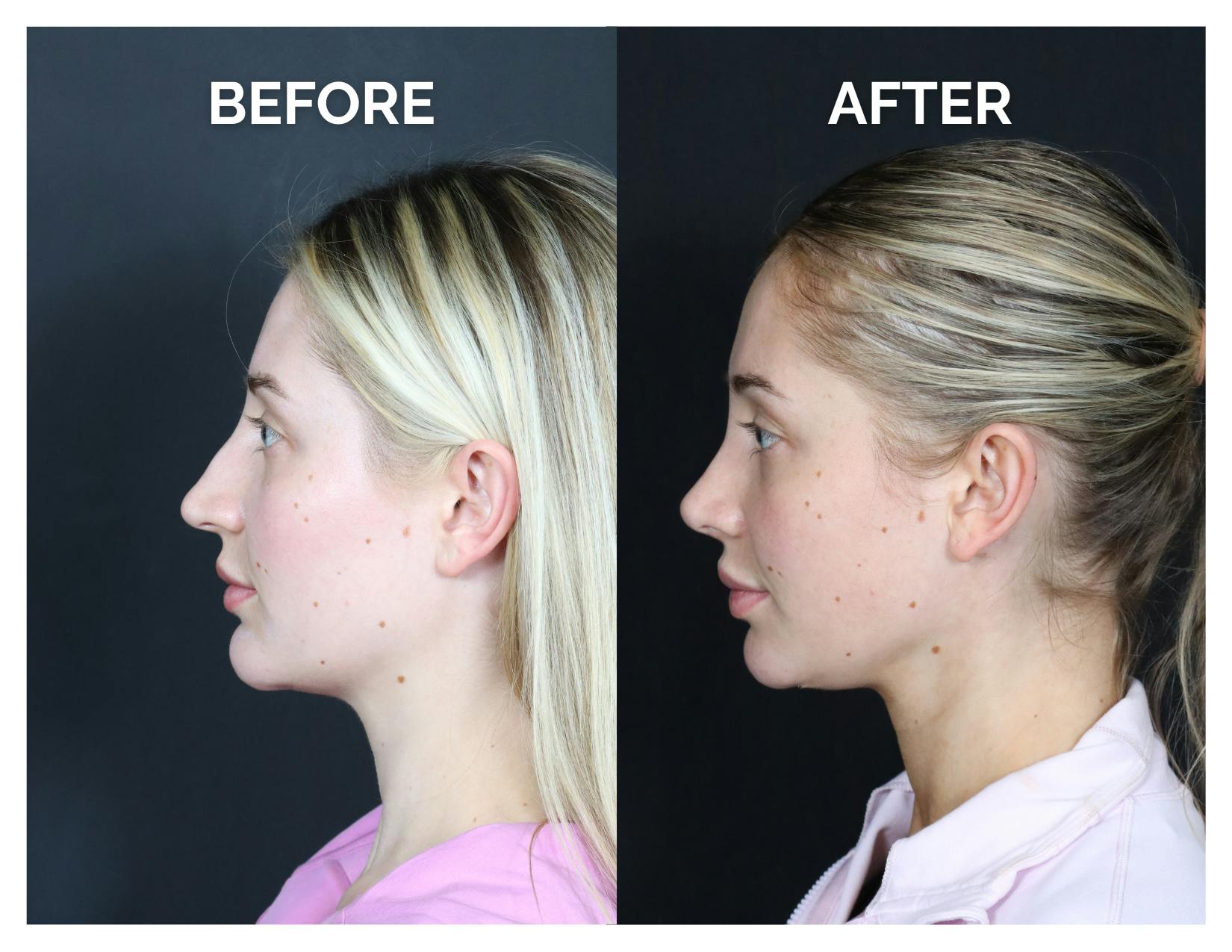 Revision Rhinoplasty Before & After Gallery - Patient 287533 - Image 5