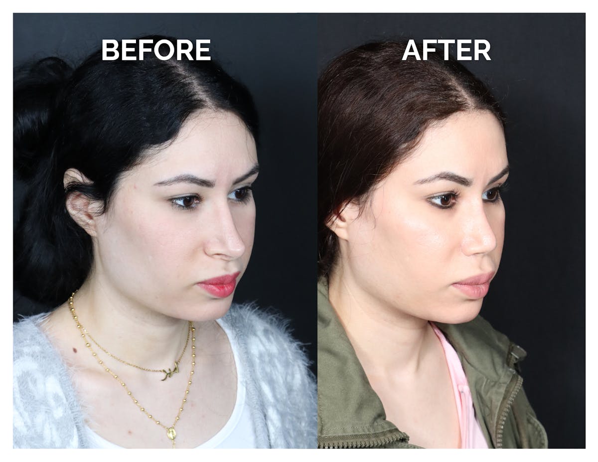 Revision Rhinoplasty Before & After Gallery - Patient 481647 - Image 1