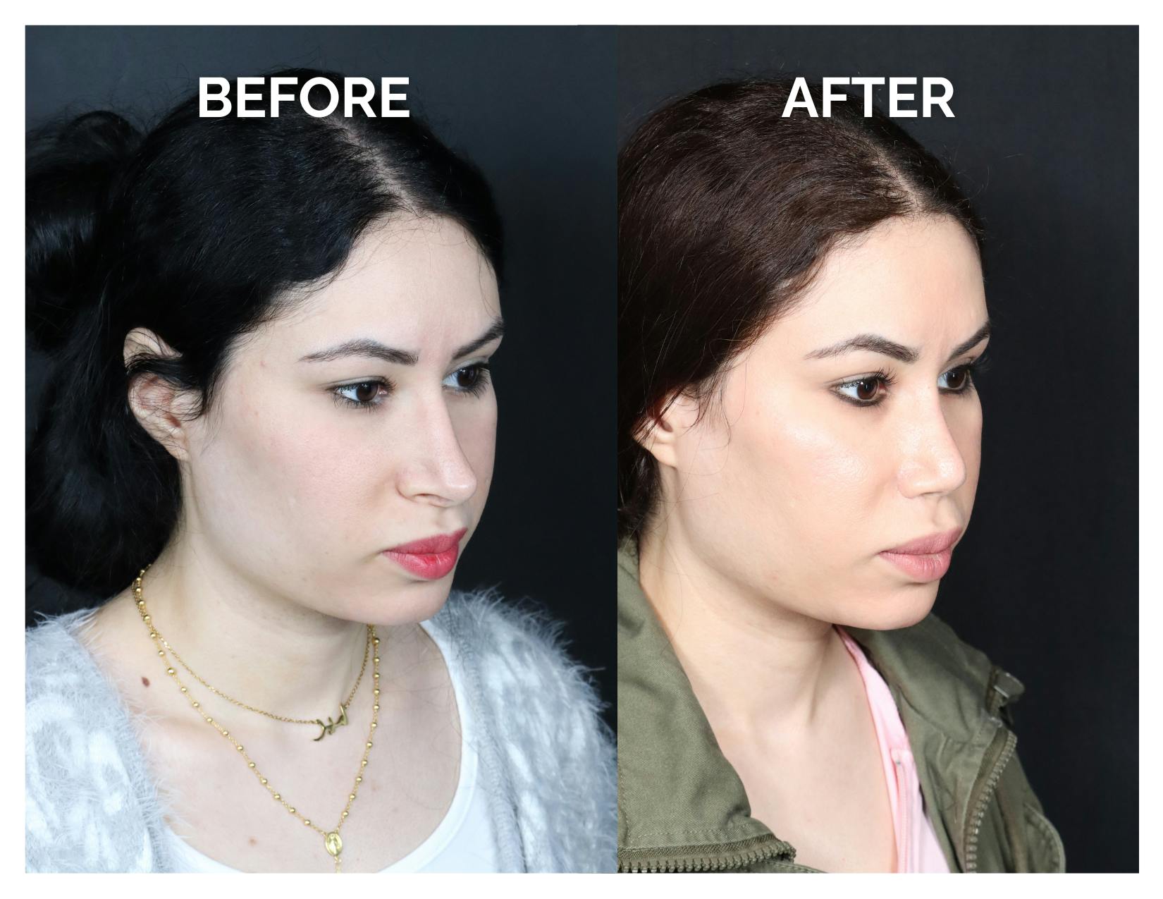 Revision Rhinoplasty Before & After Gallery - Patient 481647 - Image 1