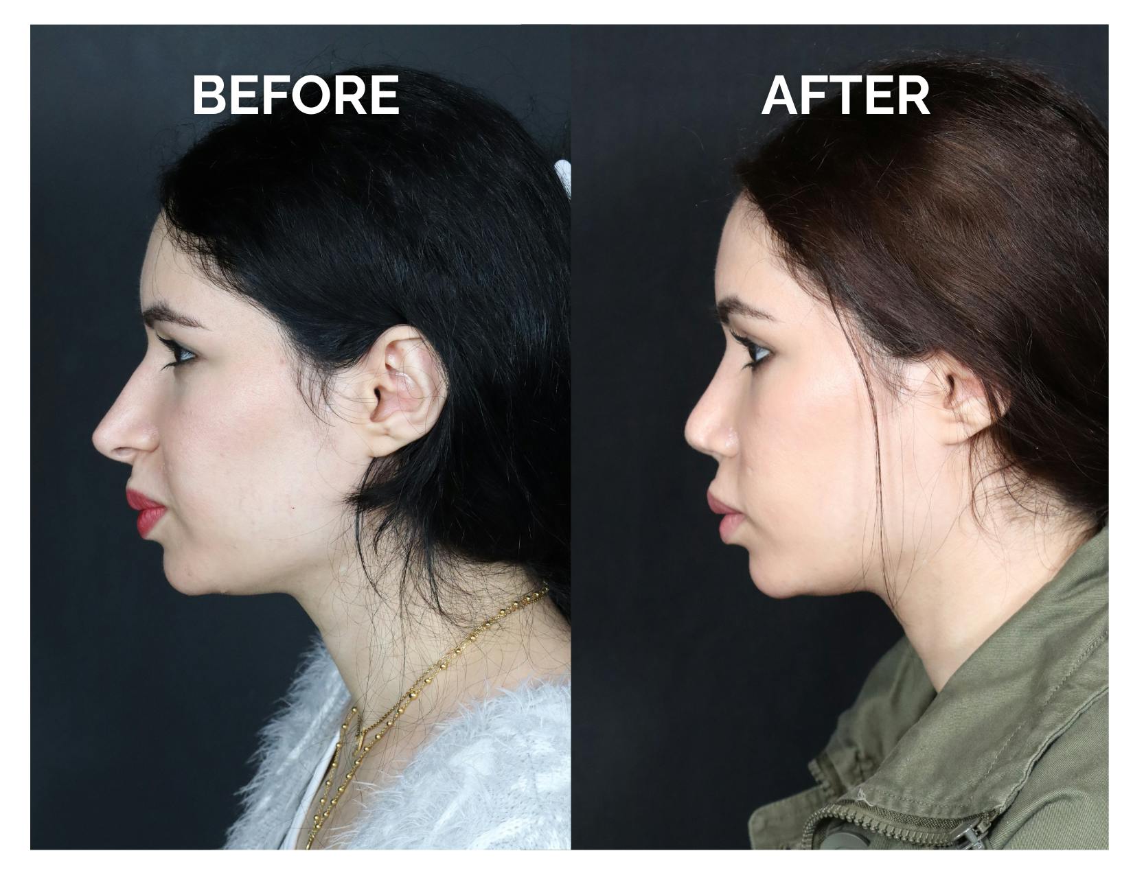 Revision Rhinoplasty Before & After Gallery - Patient 481647 - Image 2