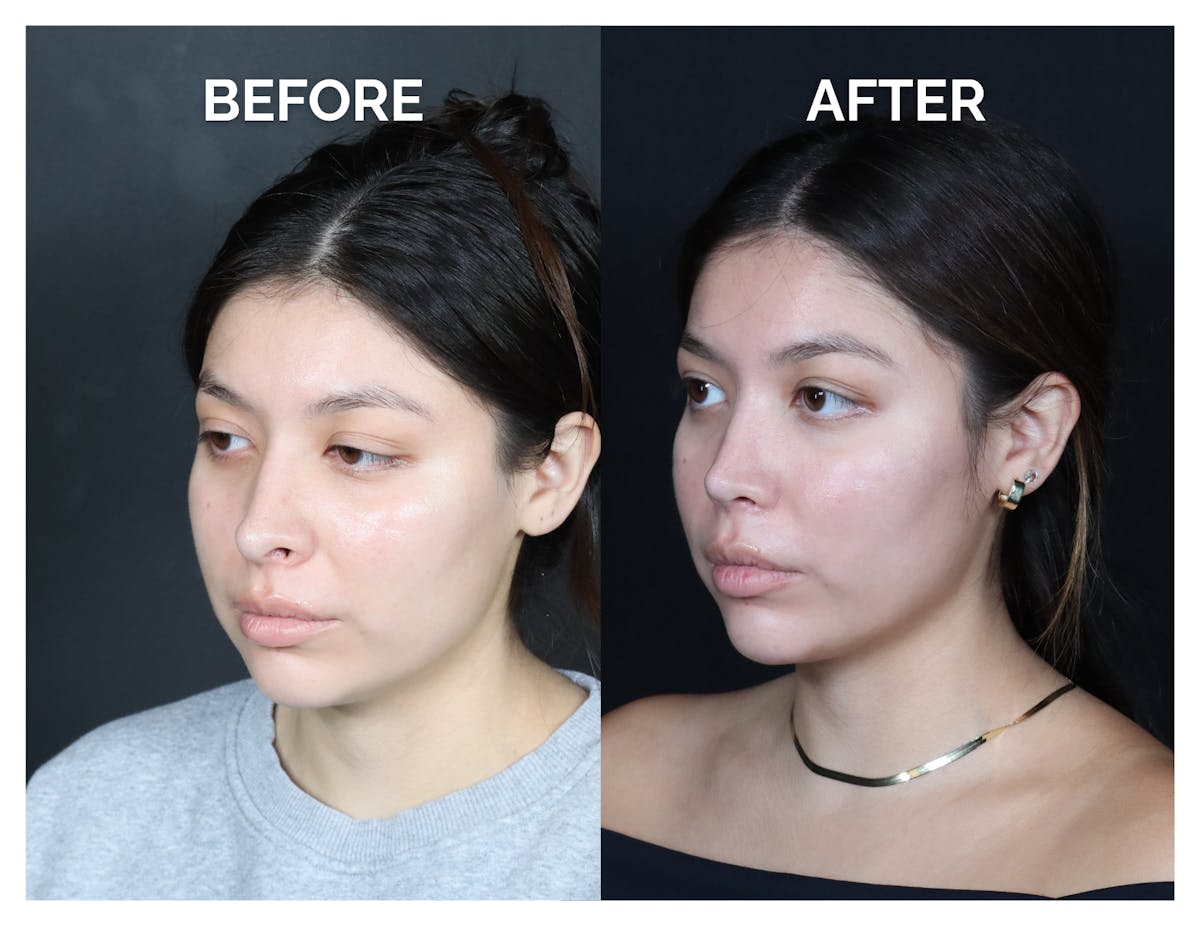 Revision Rhinoplasty Before & After Gallery - Patient 375641 - Image 4