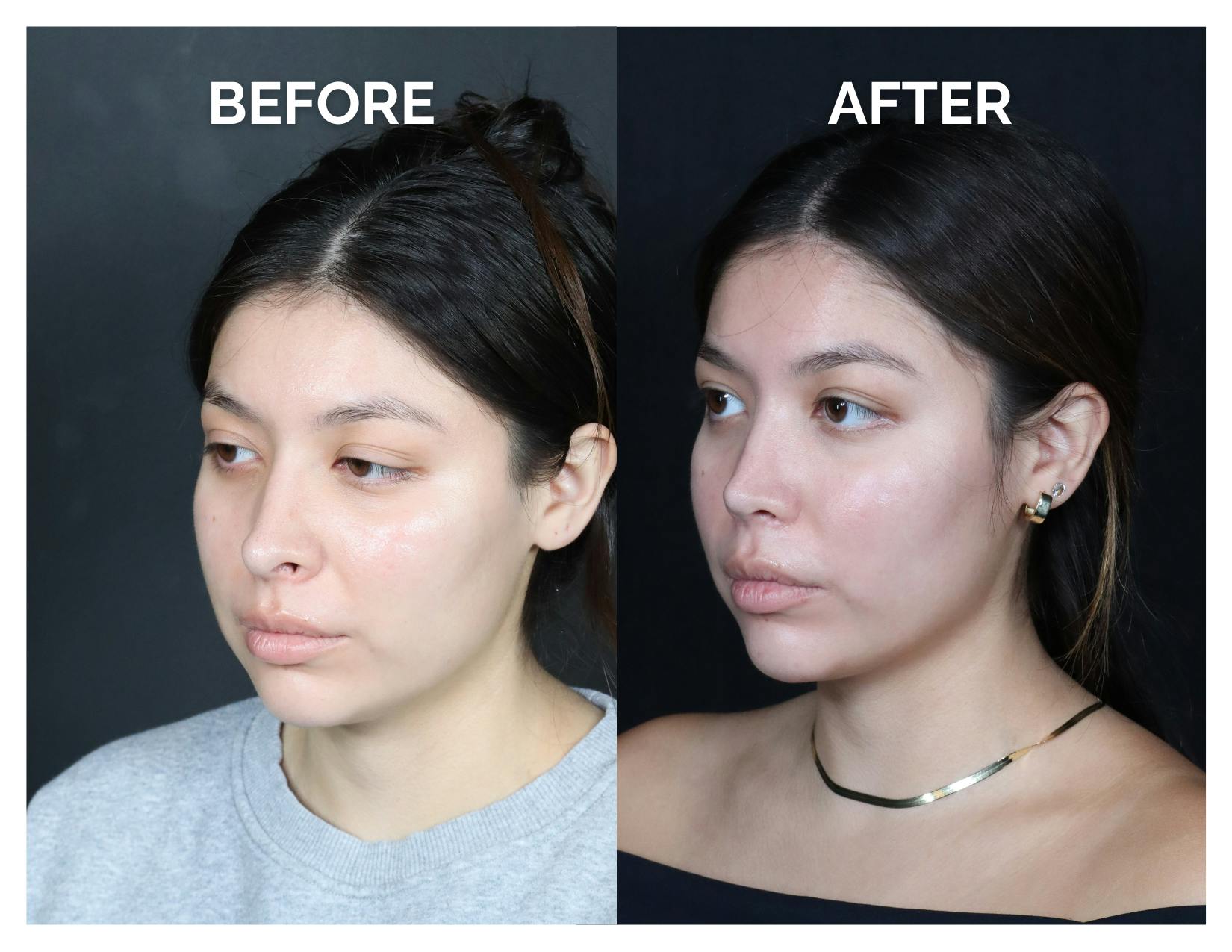 Revision Rhinoplasty Before & After Gallery - Patient 375641 - Image 4