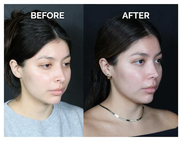 Revision Rhinoplasty Before & After Gallery - Patient 375641 - Image 1