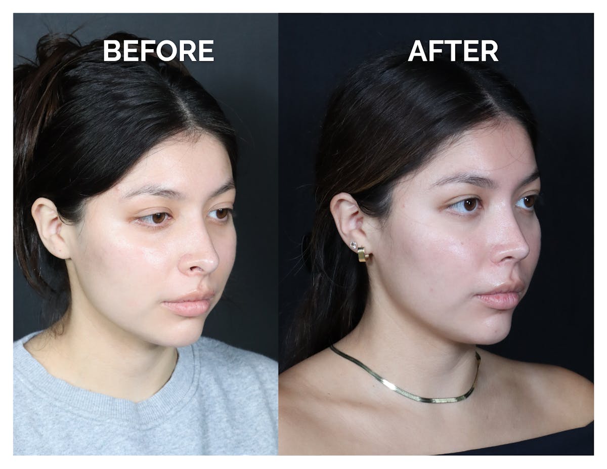Revision Rhinoplasty Before & After Gallery - Patient 375641 - Image 2