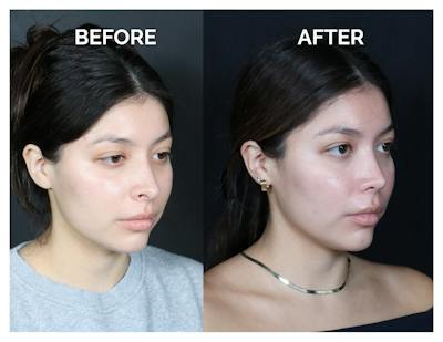 Revision Rhinoplasty Before & After Gallery - Patient 375641 - Image 1