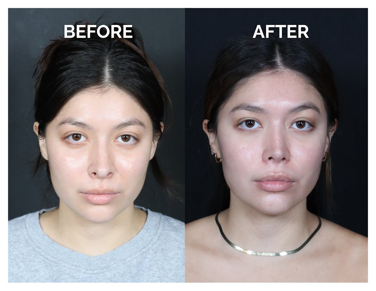 Revision Rhinoplasty Before & After Gallery - Patient 375641 - Image 1