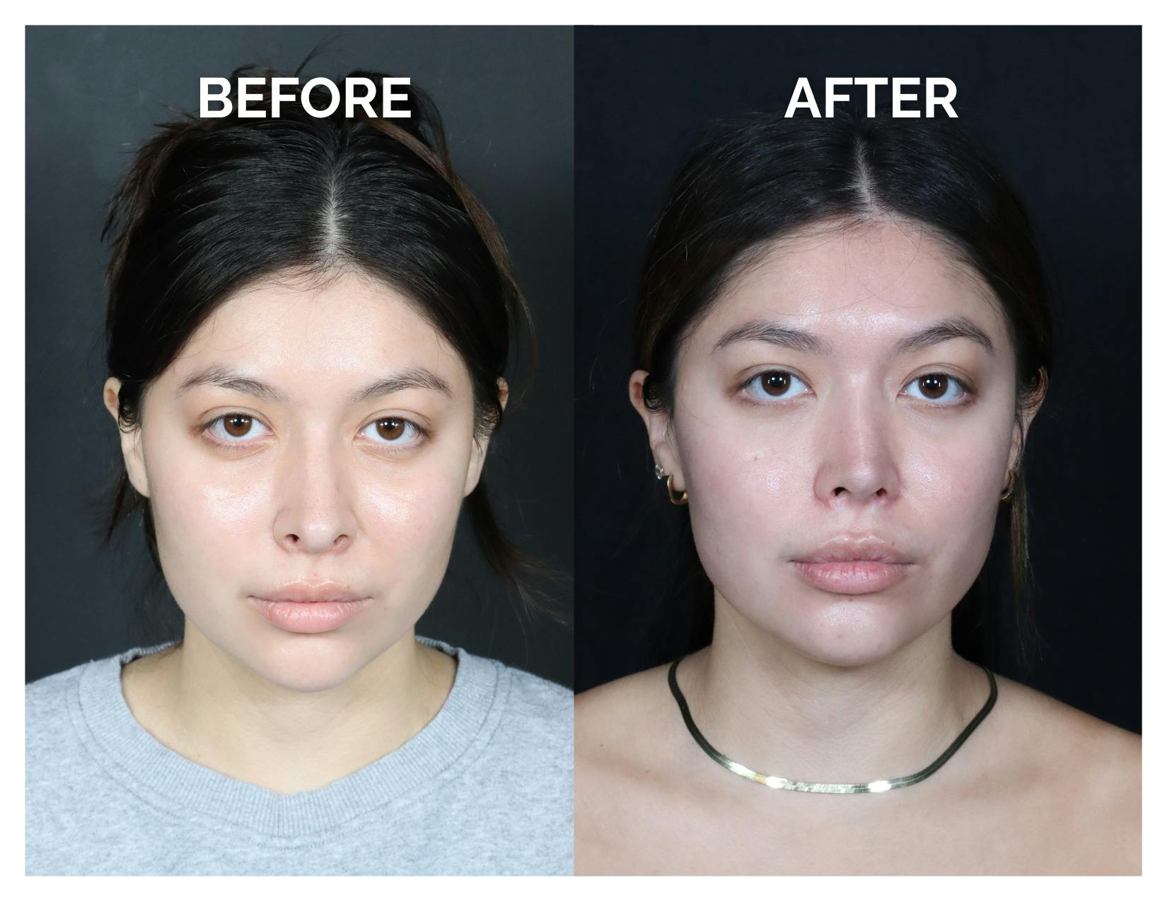 Revision Rhinoplasty Before & After Gallery - Patient 375641 - Image 1