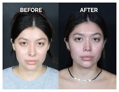 Revision Rhinoplasty Before & After Gallery - Patient 375641 - Image 1