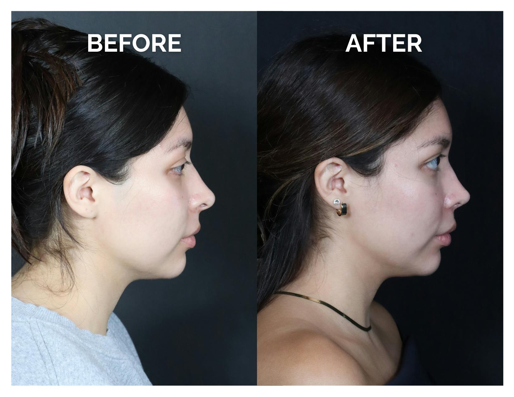 Revision Rhinoplasty Before & After Gallery - Patient 375641 - Image 3