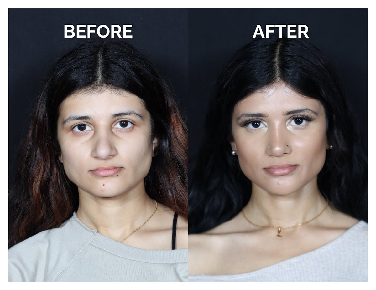 Revision Rhinoplasty Before & After Gallery - Patient 330394 - Image 1