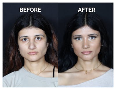 Revision Rhinoplasty Before & After Gallery - Patient 330394 - Image 1