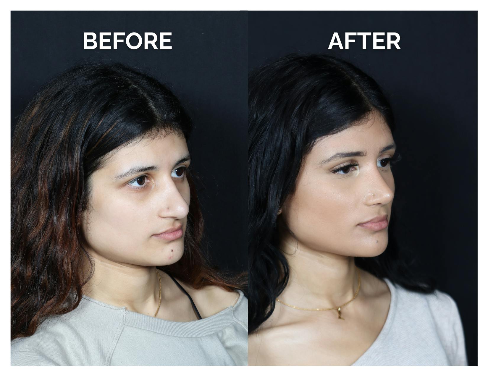 Revision Rhinoplasty Before & After Gallery - Patient 330394 - Image 2