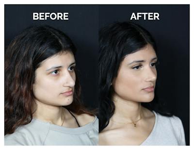 Revision Rhinoplasty Before & After Gallery - Patient 330394 - Image 1