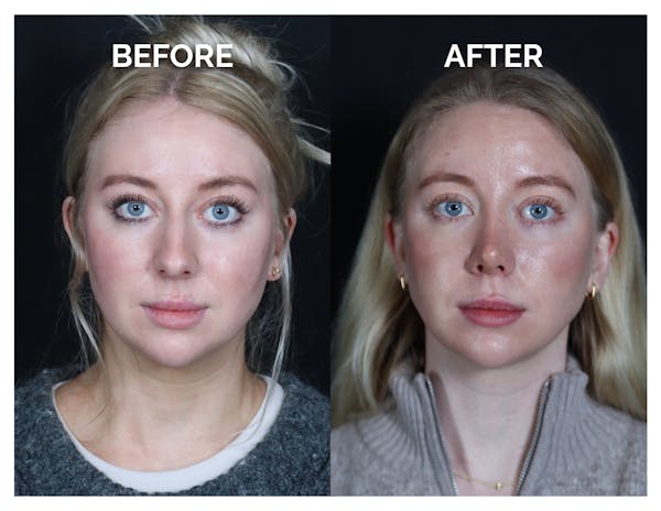 Revision Rhinoplasty Before & After Gallery - Patient 643963 - Image 1