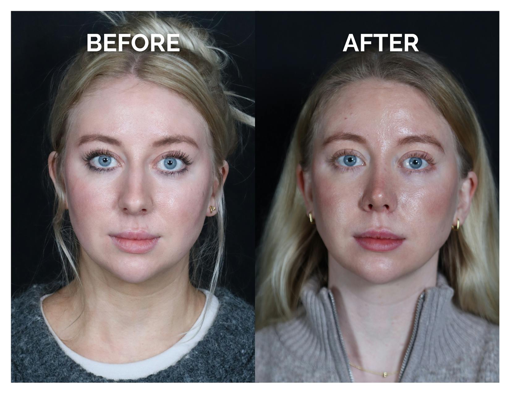 Revision Rhinoplasty Before & After Gallery - Patient 643963 - Image 1