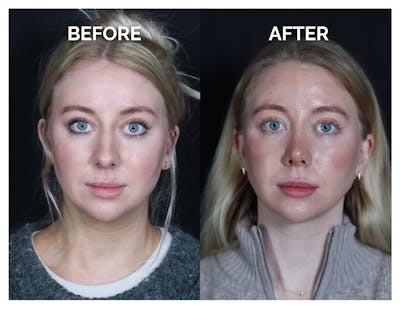 Revision Rhinoplasty Before & After Gallery - Patient 643963 - Image 1