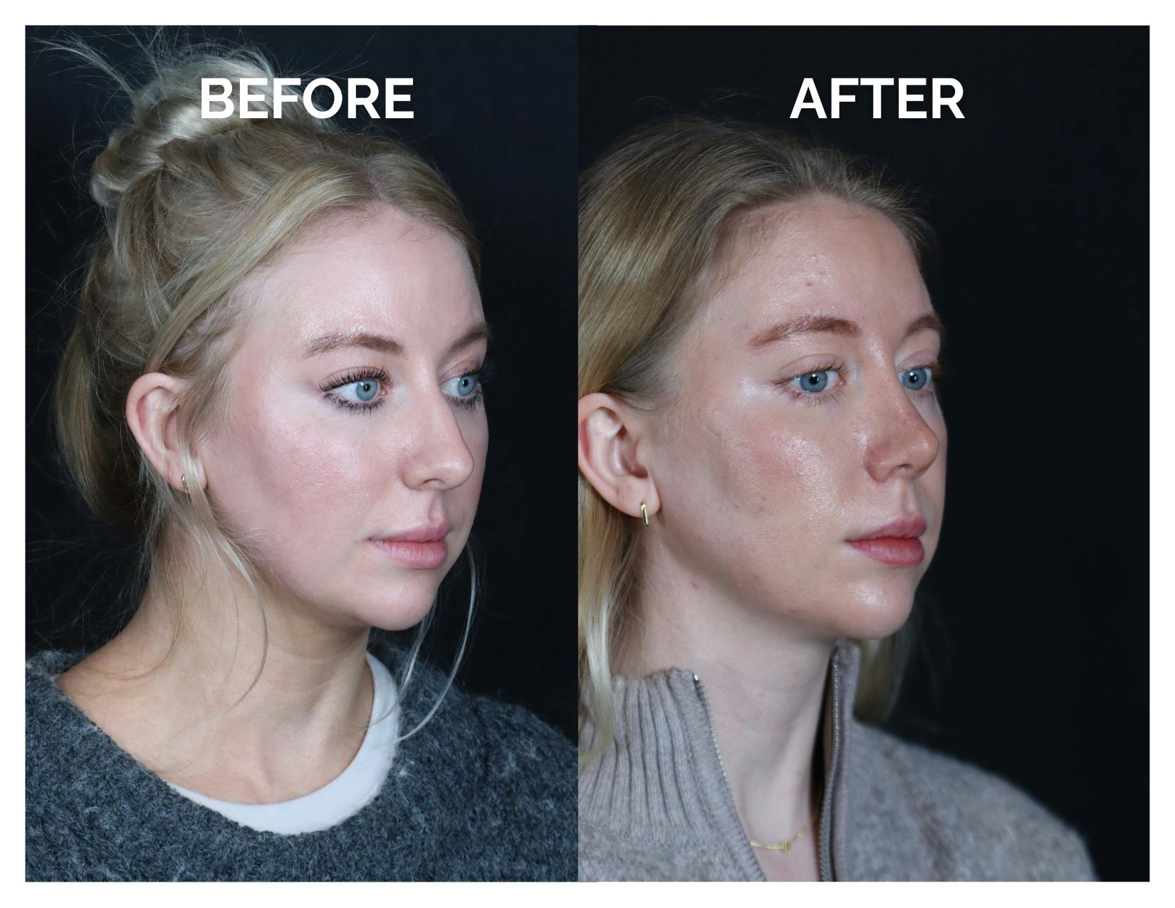 Revision Rhinoplasty Before & After Gallery - Patient 643963 - Image 2